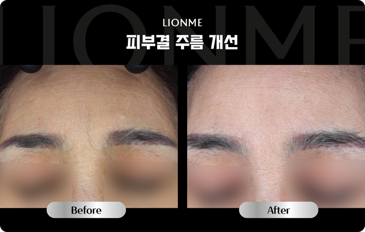 피부결 주름 개선